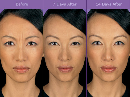 Dermal Fillers in Howell