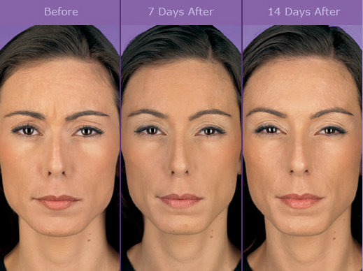 Dermal Fillers in Manasquan